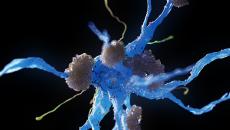 Nerve cells affected by Alzheimer's disease